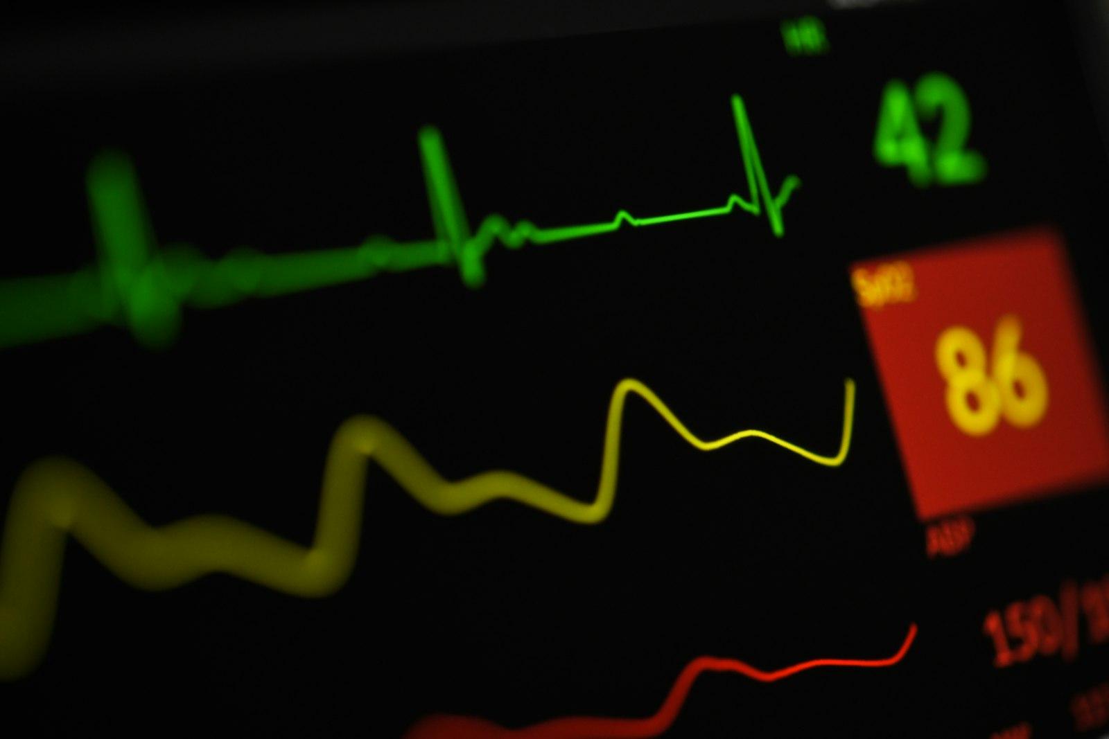 Monitor de signos vitales mostrando trazo electrocardiográfico en un procedimiento cardiovascular