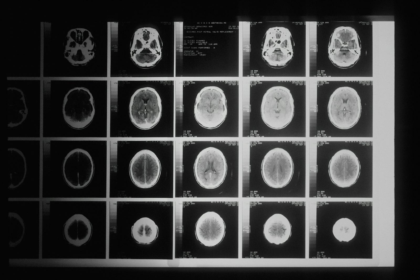 Imágenes de tomografía cerebral utilizadas en procedimientos neurointervencionistas